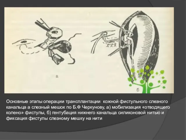 Основные этапы операции трансплантации кожной фистульного слезного канальца а слезный