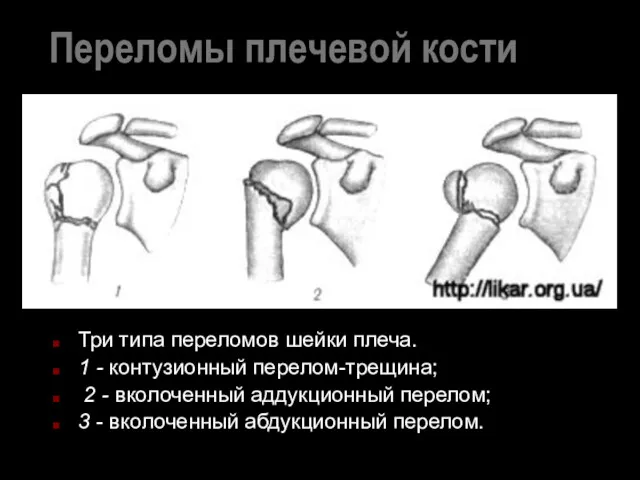 Переломы плечевой кости Три типа переломов шейки плеча. 1 -