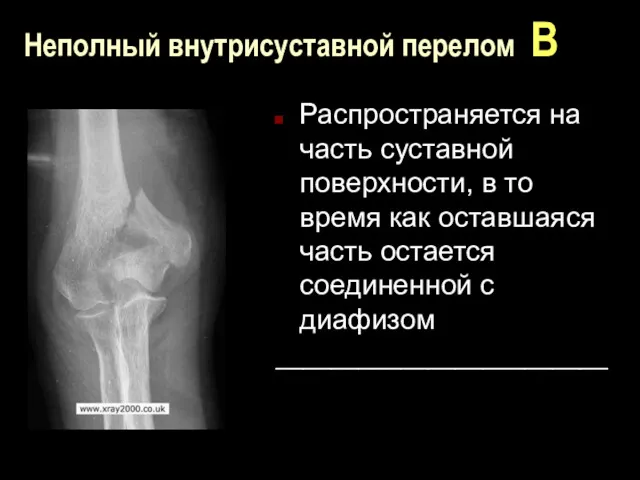 Неполный внутрисуставной перелом В Распространяется на часть суставной поверхности, в