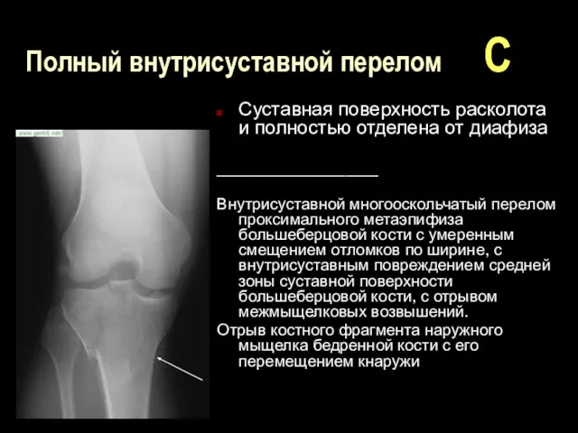 Полный внутрисуставной перелом С Суставная поверхность расколота и полностью отделена