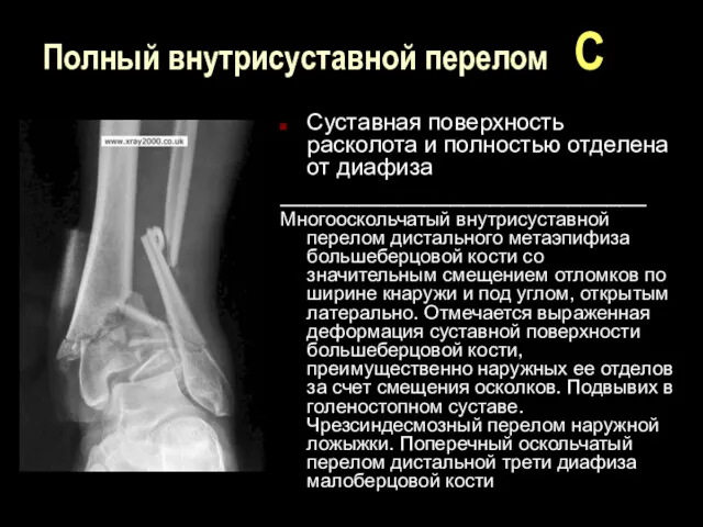 Полный внутрисуставной перелом С Суставная поверхность расколота и полностью отделена