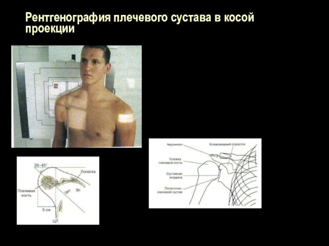 Рентгенография плечевого сустава в косой проекции