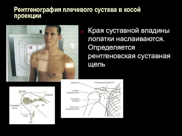 Рентгенография плечевого сустава в косой проекции Края суставной впадины лопатки наслаиваются. Определяется рентгеновская суставная щель