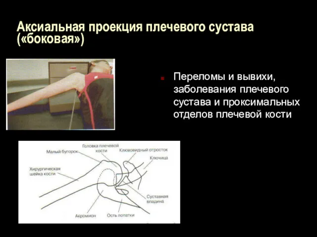 Аксиальная проекция плечевого сустава («боковая») Переломы и вывихи, заболевания плечевого сустава и проксимальных отделов плечевой кости