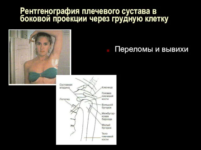 Рентгенография плечевого сустава в боковой проекции через грудную клетку Переломы и вывихи