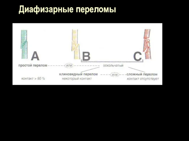 Диафизарные переломы