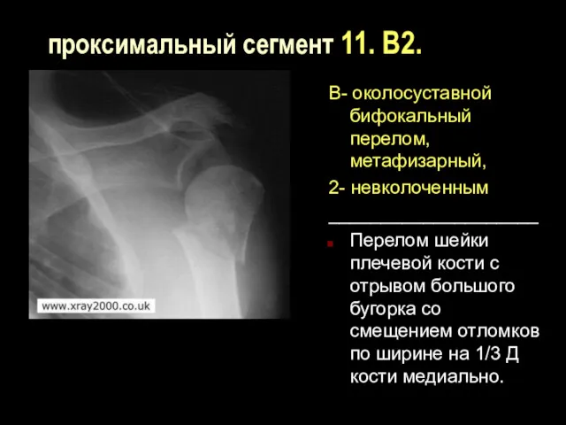 проксимальный сегмент 11. В2. В- околосуставной бифокальный перелом, метафизарный, 2-