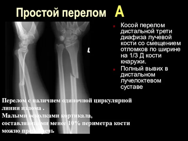 Простой перелом А Косой перелом дистальной трети диафиза лучевой кости