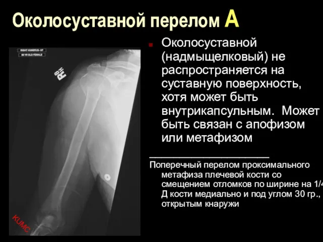 Околосуставной перелом А Околосуставной (надмыщелковый) не распространяется на суставную поверхность,