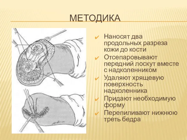 МЕТОДИКА Наносят два продольных разреза кожи до кости Отсепаровывают передний