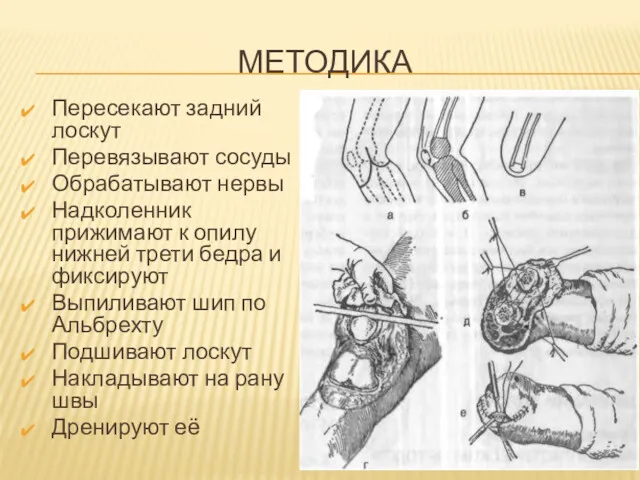 МЕТОДИКА Пересекают задний лоскут Перевязывают сосуды Обрабатывают нервы Надколенник прижимают к опилу нижней