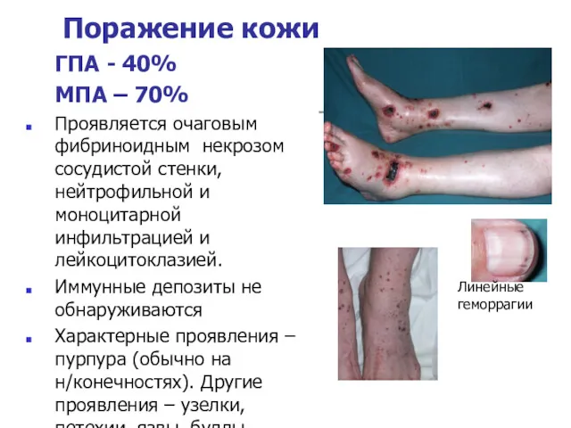Линейные геморрагии Поражение кожи ГПА - 40% МПА – 70%