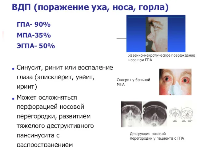 Язвенно-некротическое повреждение носа при ГПА Деструкция носовой перегородки у пациента