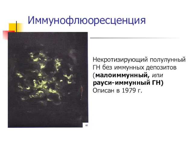 Иммунофлюоресценция Некротизирующий полулунный ГН без иммунных депозитов (малоиммунный, или рауси-иммунный