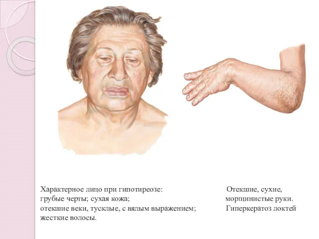 Характерное лицо при гипотиреозе: Отекшие, сухие, грубые черты; сухая кожа;