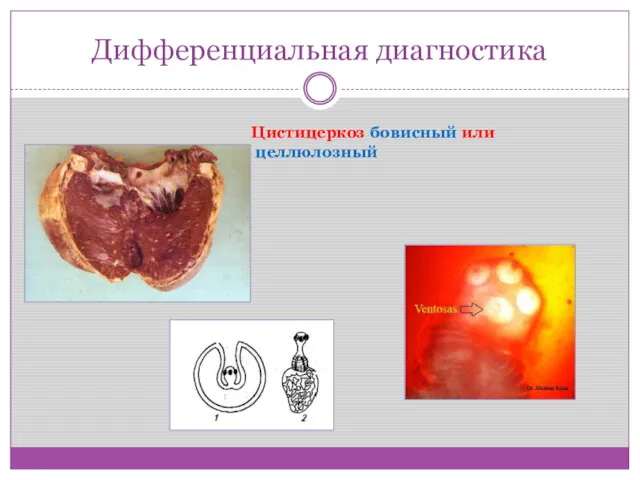 Дифференциальная диагностика Цистицеркоз бовисный или целлюлозный