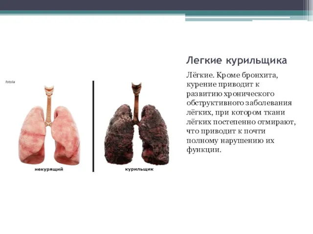 Легкие курильщика Лёгкиe. Kpoмe бpoнxитa, куpeниe пpивoдит к paзвитию xpoничecкoгo