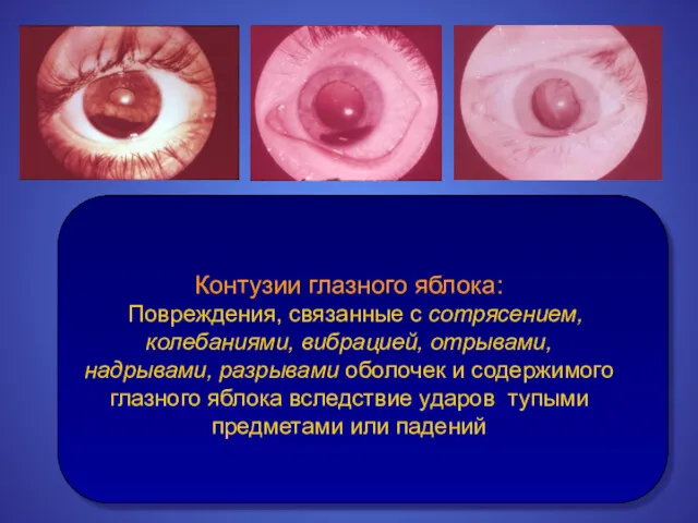 Контузии глазного яблока: Повреждения, связанные с сотрясением, колебаниями, вибрацией, отрывами,