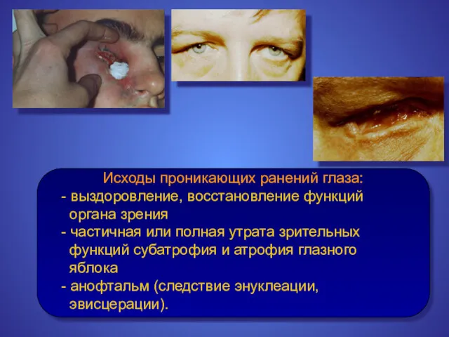 Исходы проникающих ранений глаза: - выздоровление, восстановление функций органа зрения