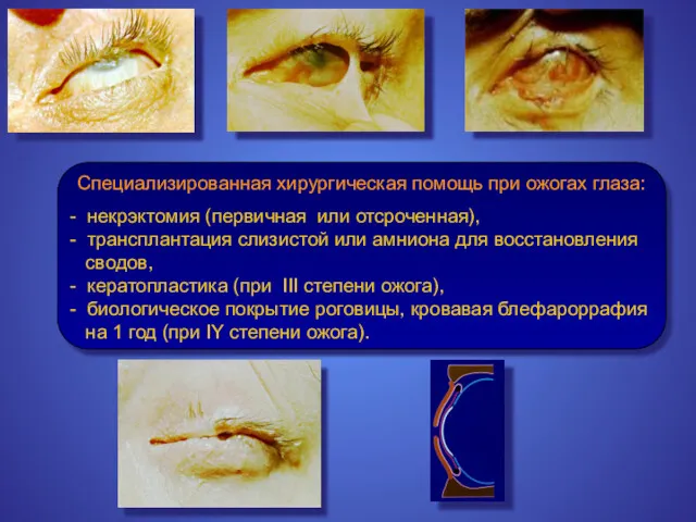 Специализированная хирургическая помощь при ожогах глаза: - некрэктомия (первичная или