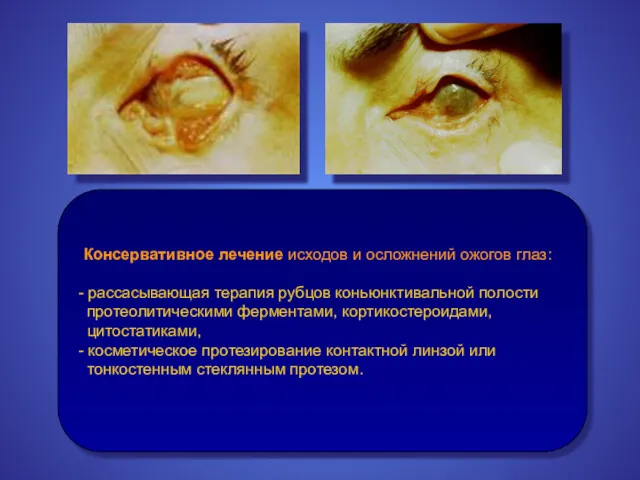 Консервативное лечение исходов и осложнений ожогов глаз: - рассасывающая терапия