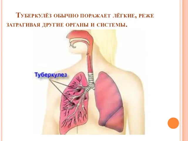 Туберкулёз обычно поражает лёгкие, реже затрагивая другие органы и системы.