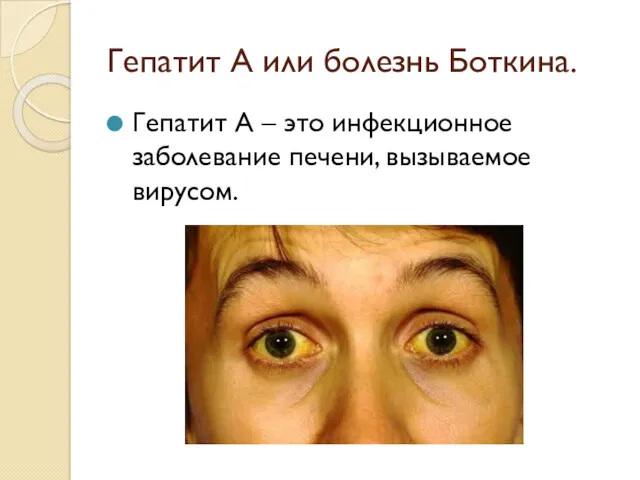 Гепатит А или болезнь Боткина. Гепатит А – это инфекционное заболевание печени, вызываемое вирусом.