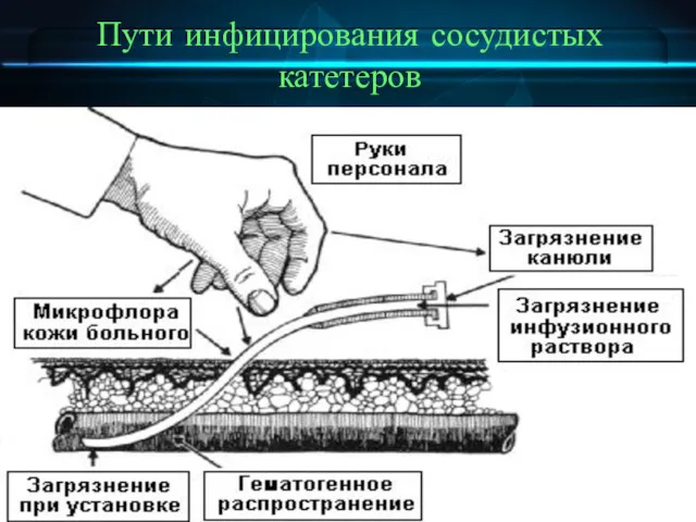 Пути инфицирования сосудистых катетеров