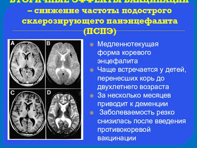 ВТОРИЧНЫЕ ЭФФЕКТЫ ВАКЦИНАЦИИ – снижение частоты подострого склерозирующего панэнцефалита (ПСПЭ)