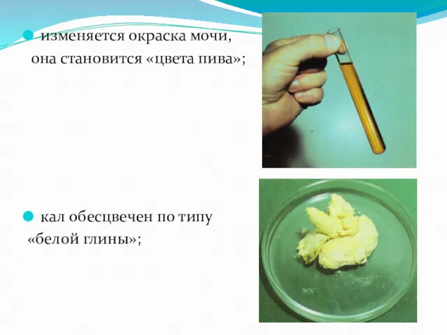 изменяется окраска мочи, она становится «цвета пива»; кал обесцвечен по типу «белой глины»;