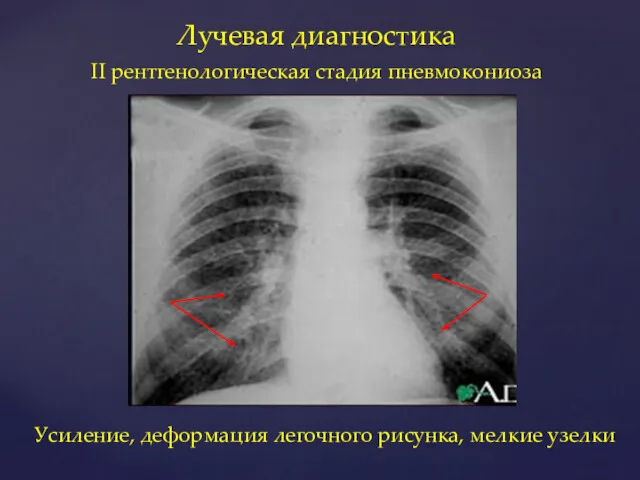 Лучевая диагностика II рентгенологическая стадия пневмокониоза Усиление, деформация легочного рисунка, мелкие узелки
