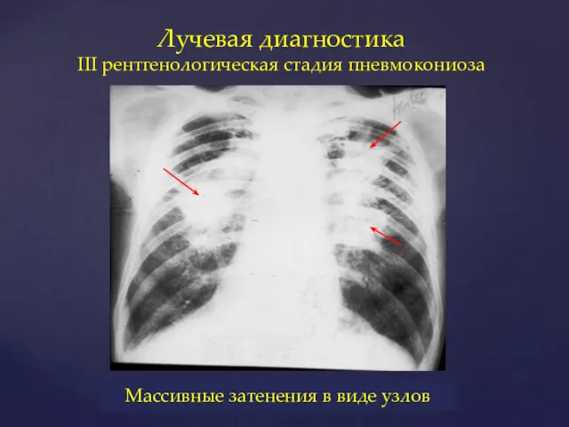 Лучевая диагностика III рентгенологическая стадия пневмокониоза Массивные затенения в виде узлов
