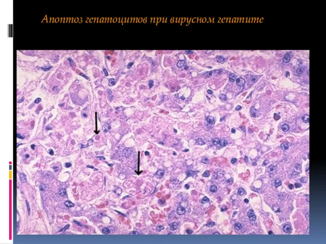 Апоптоз гепатоцитов при вирусном гепатите
