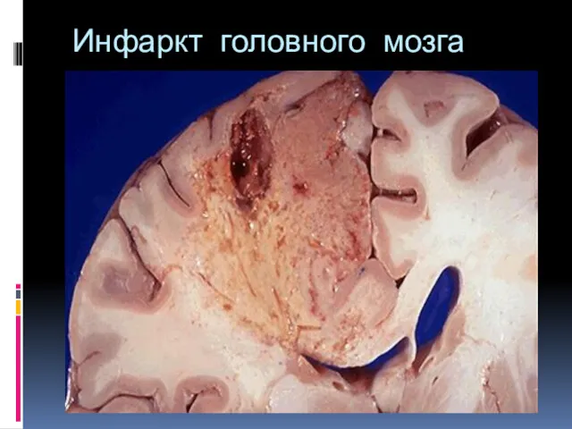 Инфаркт головного мозга