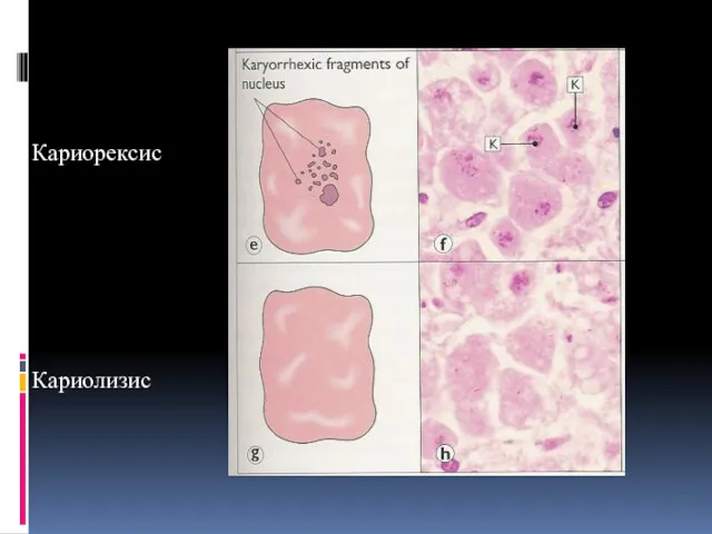 Кариорексис Кариолизис