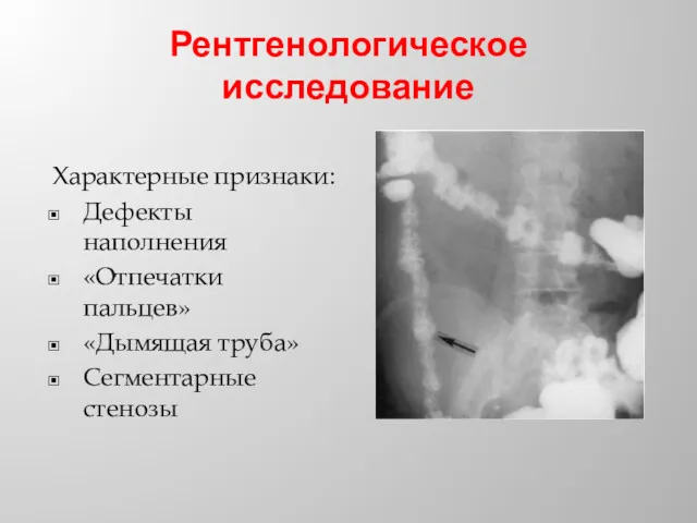 Рентгенологическое исследование Характерные признаки: Дефекты наполнения «Отпечатки пальцев» «Дымящая труба» Сегментарные стенозы
