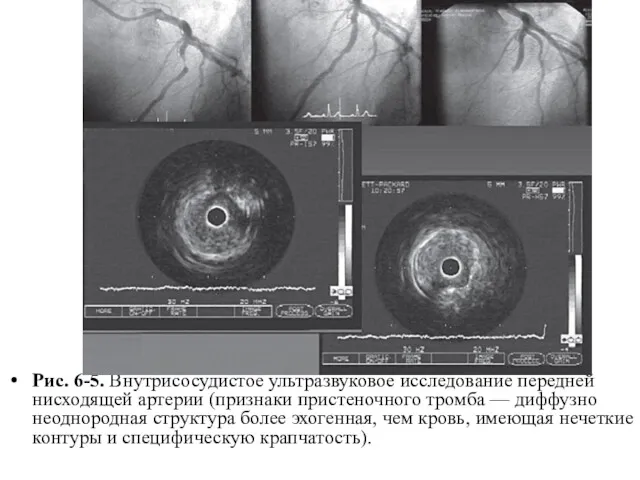 Рис. 6-5. Внутрисосудистое ультразвуковое исследование передней нисходящей артерии (признаки пристеночного тромба — диффузно