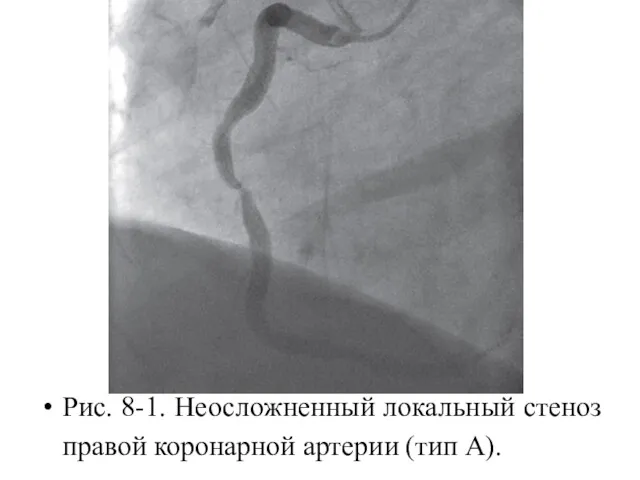 Рис. 8-1. Неосложненный локальный стеноз правой коронарной артерии (тип А).