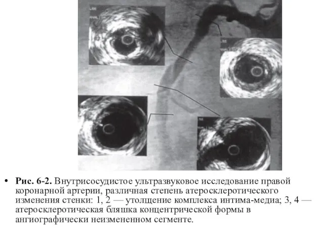 Рис. 6-2. Внутрисосудистое ультразвуковое исследование правой коронарной артерии, различная степень атеросклеротического изменения стенки: