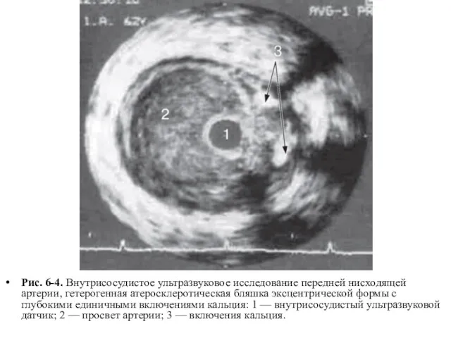 Рис. 6-4. Внутрисосудистое ультразвуковое исследование передней нисходящей артерии, гетерогенная атеросклеротическая бляшка эксцентрической формы