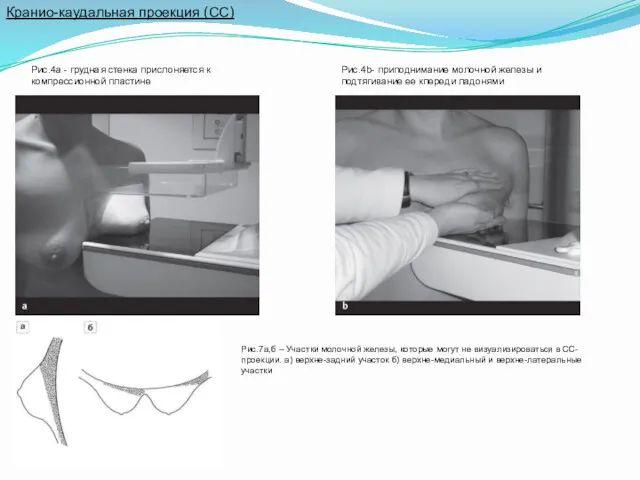 Кранио-каудальная проекция (СС) Рис.4а - грудная стенка прислоняется к компрессионной