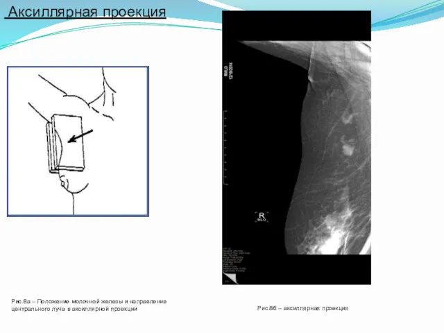 Аксиллярная проекция Рис.8а – Положение молочной железы и направление центрального