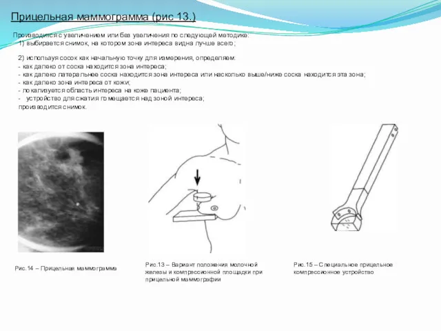 Прицельная маммограмма (рис 13.) Производится с увеличением или без увеличения