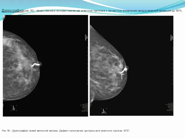 Дуктография(рис.16) - искусственное контрастирование млечных протоков с точностью выявления патологической