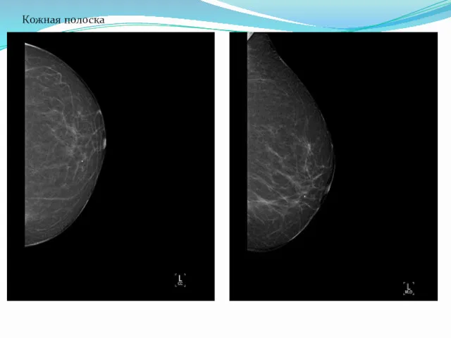 Рис.2 – Маммограмма левой молочной железы. Инволютивная молочная железа. Кожная полоска