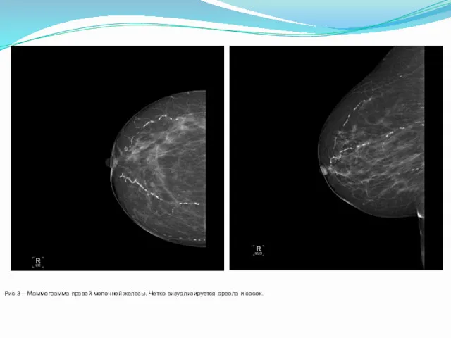 Рис.3 – Маммограмма правой молочной железы. Четко визуализируется ареола и сосок.