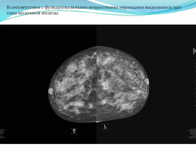 В соответствии с функциональными возрастными периодами выделяются три типа молочной железы.