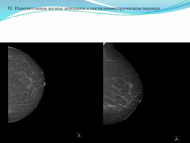 IV. Инволютивная железа женщины в постклимактерическом периоде