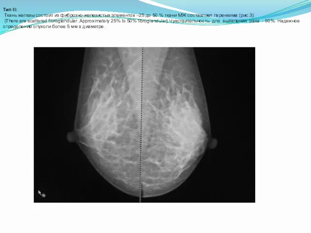 Тип II: Ткань железы состоит из фиброзно-железистых элементов –25 до