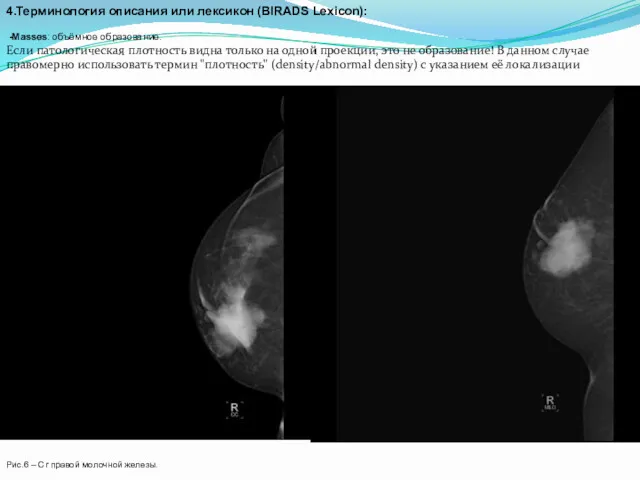 4.Терминология описания или лексикон (BIRADS Lexicon): -Masses: объёмное образование. Если